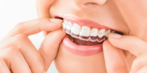 Invisialign Dental Treatment